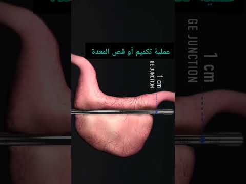 هكذا تتم عملية تكميم المعدة أو قص المعدة