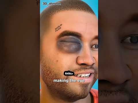 ماذا يحدث عندما تتعرض لضربة في العين بصريات Eyes عيون فحص النظر