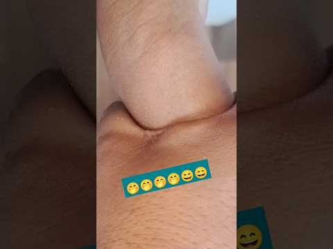 Cannulation Video Part 359 Shorts Viral Trending 2023 Cannulation Video Part 359 Shorts Viral Trending 2023