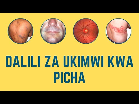 ATTENTION Zifahamu Dalili Za UKIMWI Kwa Kuangalia Picha