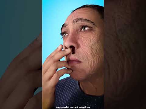 الطريقة الصحيحة لإيقاف نزيف الأنف Shorts