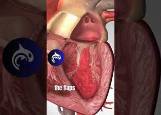 Mitral Valve Prolapse Explained 3D Animation