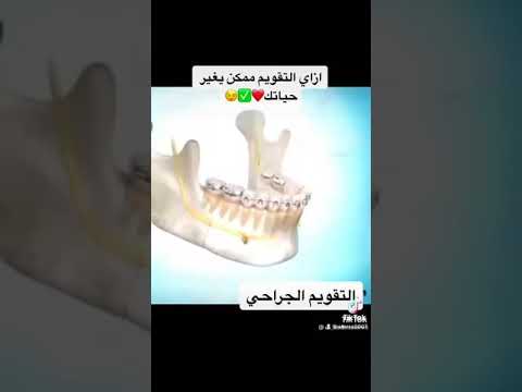 Dentist Dentistry اسنان بغداد ترند مجتمع Orthodontic تقويم جراحي Orthognathic