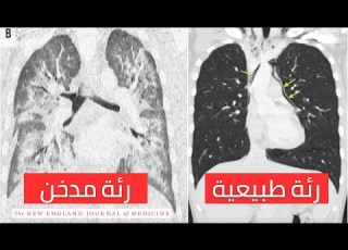  ماذا تسبب السجائر الإلكترونية أو الفيب للرئة