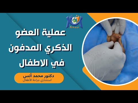 عملية العضو الذكري المدفون في الاطفال دكتور محمد أنس