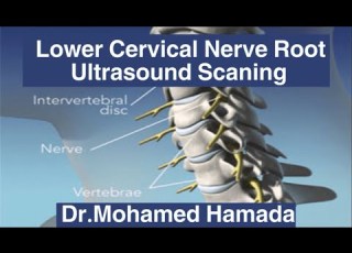  Lower Cervical Nerve Roots Ultrasound Scaning Dr Mohamed Hamada