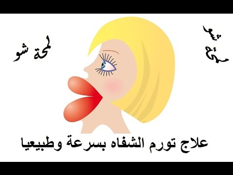 ستة 6 طرق لعلاج تورم الشفاه بسرعة وطبيعيا ستة 6 طرق لعلاج تورم الشفاه بسرعة وطبيعيا