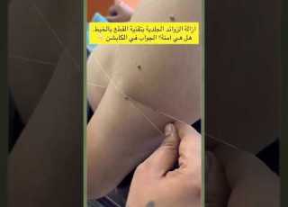 إزالة الزوائد الجلدية بتقنية القطع بالخيط هل هي آمنه الجواب في الوصف اسفل الفيديو