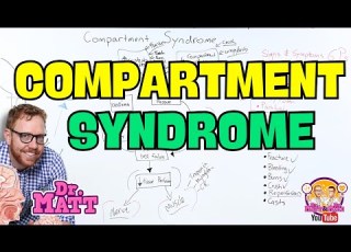 Compartment Syndrome