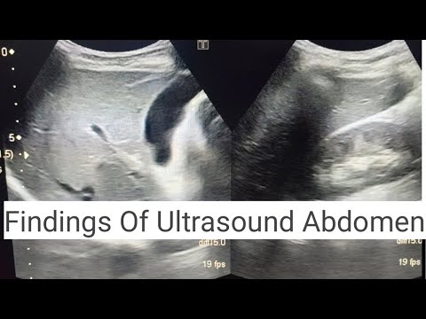 How To Perform Ultrasound Abdomen Finding Of Liver Kidney Gallbladder Scan Ultrasoundmadeeasy86