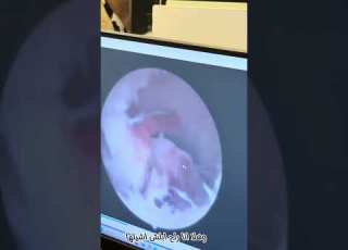 عملية المنظار الرحمي د نسرين الحوامدة