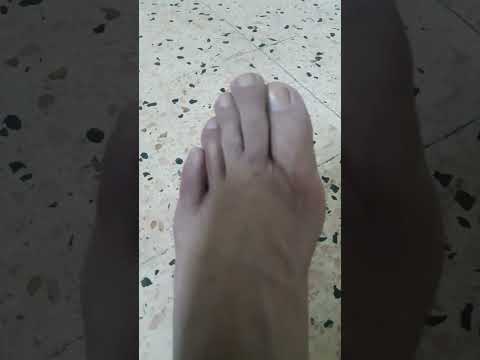 نقص التروية في الاقدام بسبب الاوعية الدموية