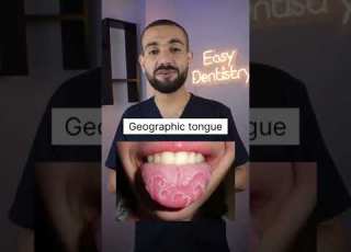 ٣ اشكال غريبه تظهر علي اللسان تشبه سرطان الفم