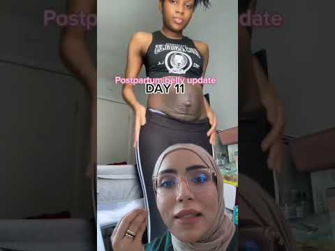 بعد الولادة تشهد العديد من النساء من ما يطلق عليه البطن الولادة