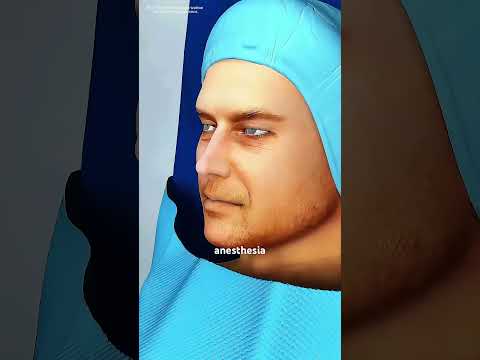 How Circumcision Surgery Is Performed 3D Animation Music Motivation Epic Like