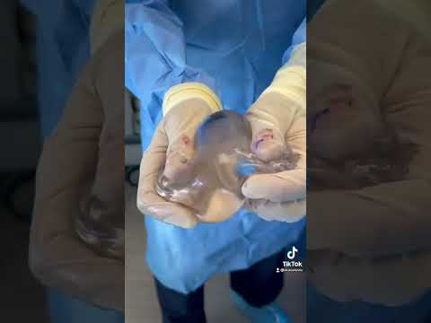 تكبير الثدي سيليكون عمليات التجميل Tiktok Dr Stuartlinder