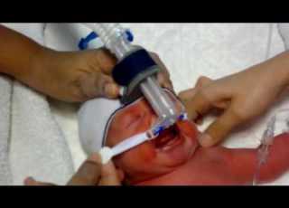  Attachment Of Bubble Nasal CPAP On A Newborn