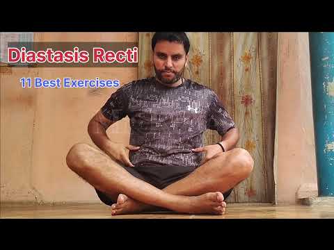 11 Best Exercises For Diastasis Recti Diastasis Diastasisrectirepair