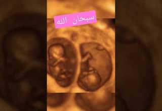 كيف يظهر التوأم داخل الرحم سبحان الله العظيم