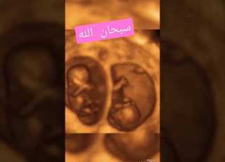 كيف يظهر التوأم داخل الرحم سبحان الله العظيم