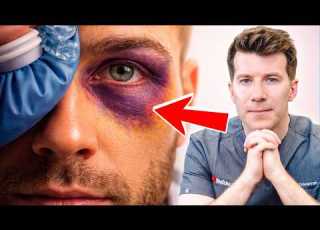  How To Treat Your BLACK EYE At Home And When To See A Doctor