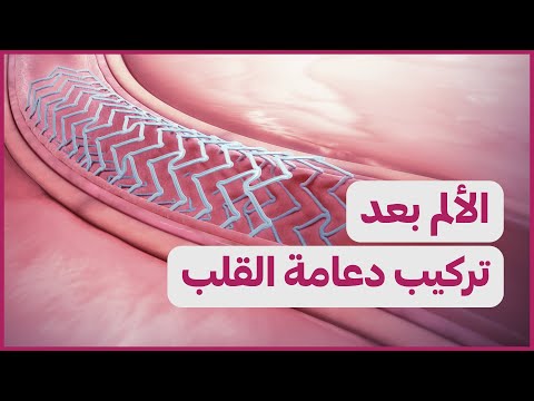 Pain After Stent الألم بعد تركيب دعامة القلب Pain After Stent الألم بعد تركيب دعامة القلب