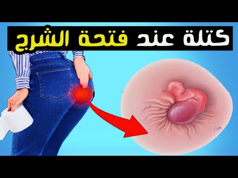 سبب وجود كتلة عند فتحة الشرج