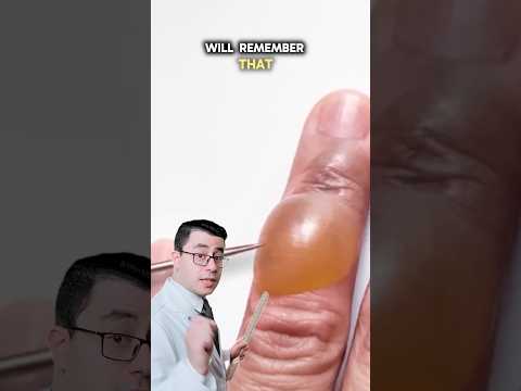 فقاعة الحروق