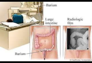 6 BARIUM ENEMA اشعه الباريوم علي القولون