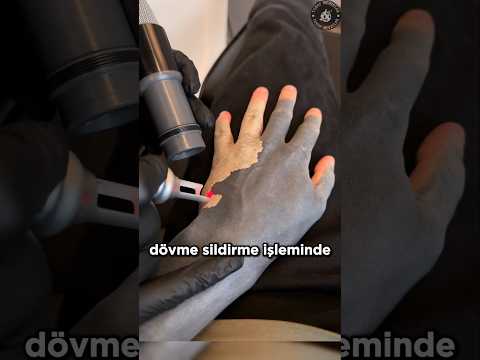 Silinen Dövmelerdeki Mürekkepler Nereye Gidiyor