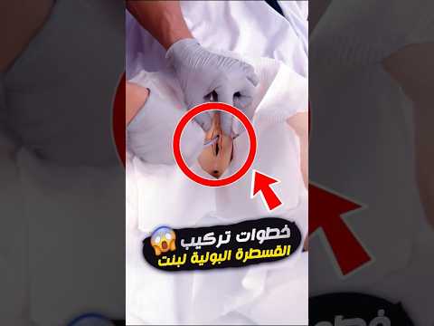قسطرة لبنت اتعلمي إزاي ترك بيها بأمان وبخطوات بسيطة Female Catheterization