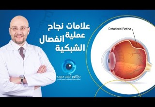 علامات نجاح عملية انفصال الشبكية دكتور أحمد حبيب