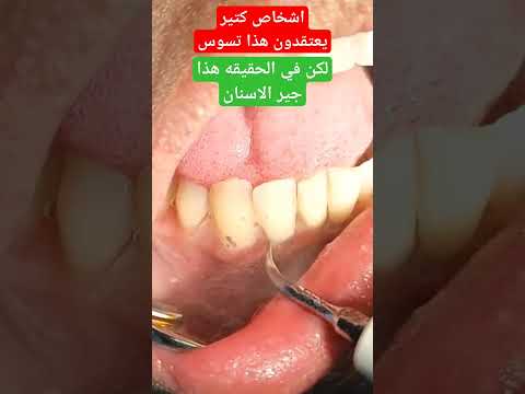جير الاسنان تحت اللثه Dental Plaque