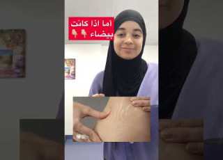هل يوجد علاج لع لامات تمدد الجلد