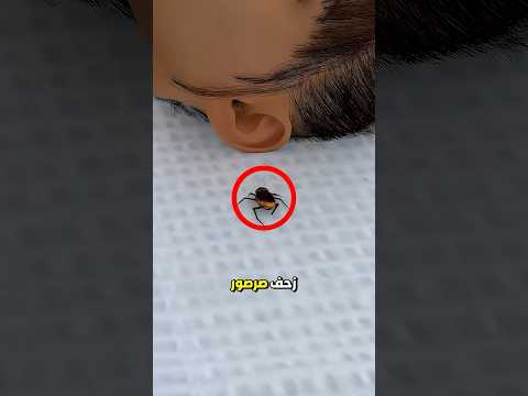 دخل صرصور الى أذنها وهي نائمة