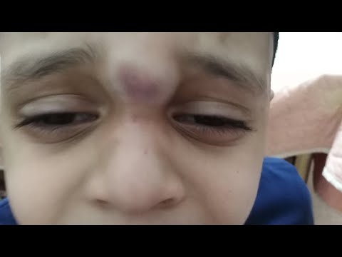 علاج طبيعي للكدمات والتورمات وبيقلل الألم فورا موجود في كل بيت علاج طبيعي للكدمات والتورمات وبيقلل الألم فورا موجود في كل بيت