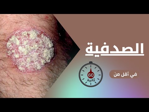 الصدفية في أقل من 60 ثانية