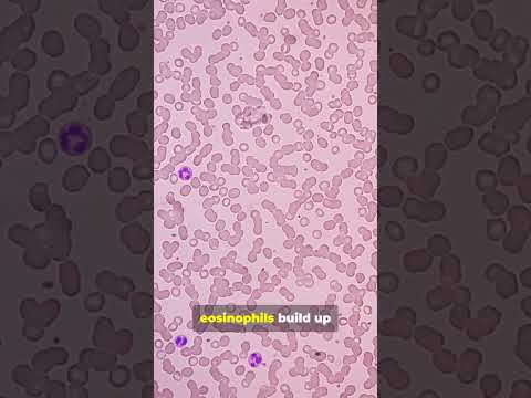 What Is Eosinophilic Esophagitis
