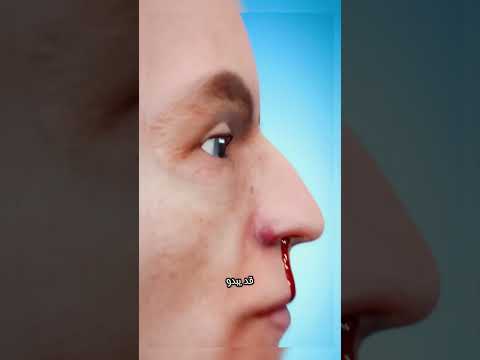 ليه بينزل دم من أنفك فجأة الحل البسيط لنزيف الأنف