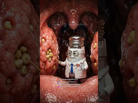 حصوات اللوز السبب الحقيقي لريحة الفم الكريهة والحل في دقيقة