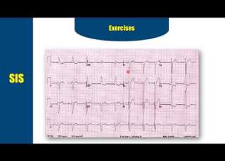 شرح تخطيط القلب ECG الحلقة السادسة QRS Complex