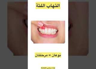  التهاب اللثة الأسباب الوقاية والعلاج