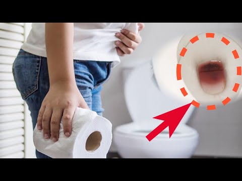 Why Do I Have Bloody Stool Initial Symptoms And Treatment Methods Of Colorectal Cancer