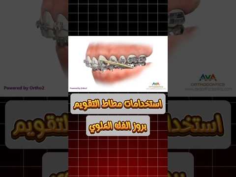 جميع استخدامات مطاط التقويم اعرف امتى ممكن تحتاج تستخدمها هل لازم
