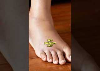 WHAT IS GOUT DR TONY SETIOBUDI