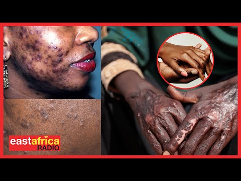 PROFESA MALEBO AFICHUA DAWA YA ASILI YA KUONDOA MAKOVU SUGU UKWELI WOTE HUU HAPA PROFESA MALEBO AFICHUA DAWA YA ASILI YA KUONDOA MAKOVU SUGU UKWELI WOTE HUU HAPA