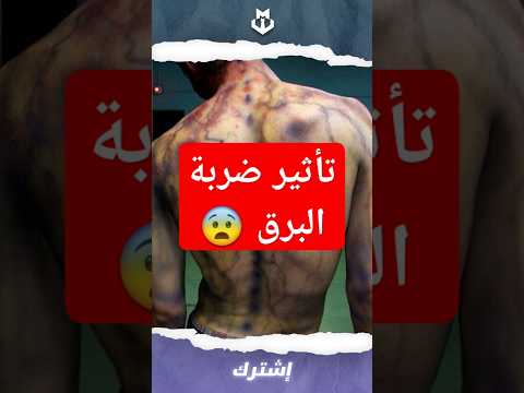 هذا تأثير ضربة البرق على الانسان