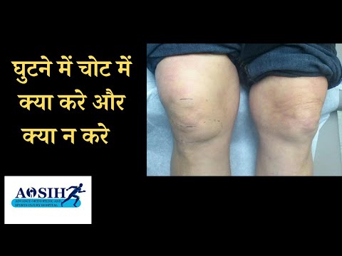 घ टन म च ट म क य कर और क य न कर Knee Injury Ya Knee Swelling Me Kin Baato Ka Dhyan Rakhe