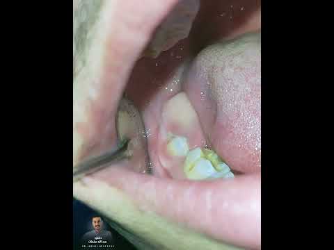 إزالة ورم حميد داخل الفم دكتور عبدالله سلطان الهنداوي إزالة ورم حميد داخل الفم دكتور عبدالله سلطان الهنداوي