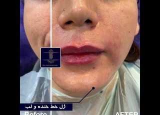 تزریق دو سی سی ژل خط لبخند و یک سی سی ژل لب
